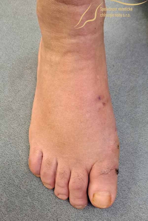 post-operative photo of a bunion on the right foot 4 weeks after surgery